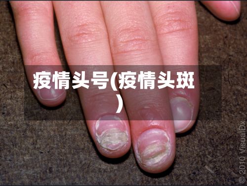 疫情头号(疫情头斑)-第2张图片