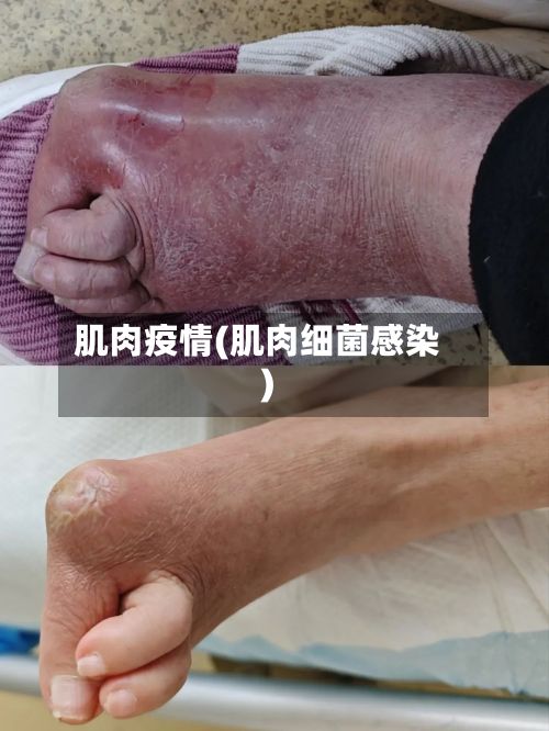 肌肉疫情(肌肉细菌感染)-第3张图片